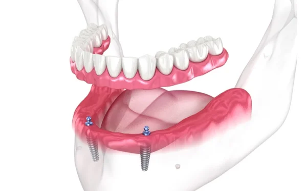 epentheti-odontostoixia-optimized